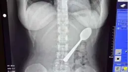 عملية لإخراج ملعقة من معدة بلجيكية