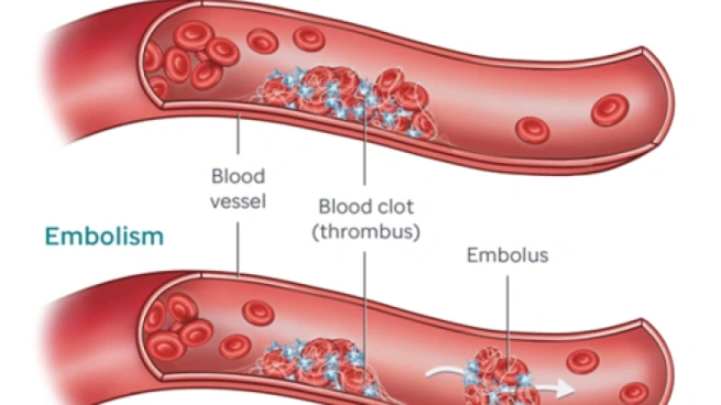 blood clotting